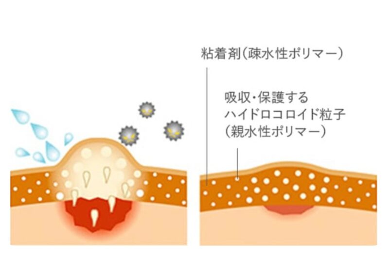 ハイドロコロイド絆創膏とは