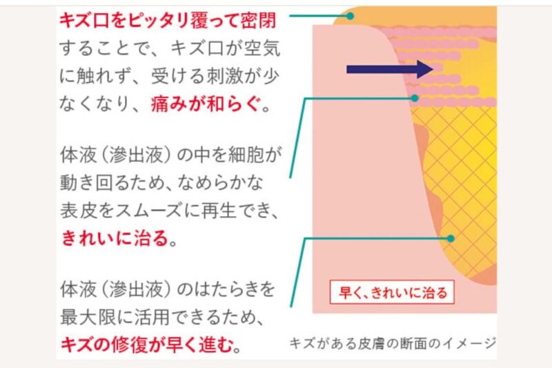 湿潤療法（モイストヒーリング）とは