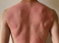 シャクティマットを使用した後の背中